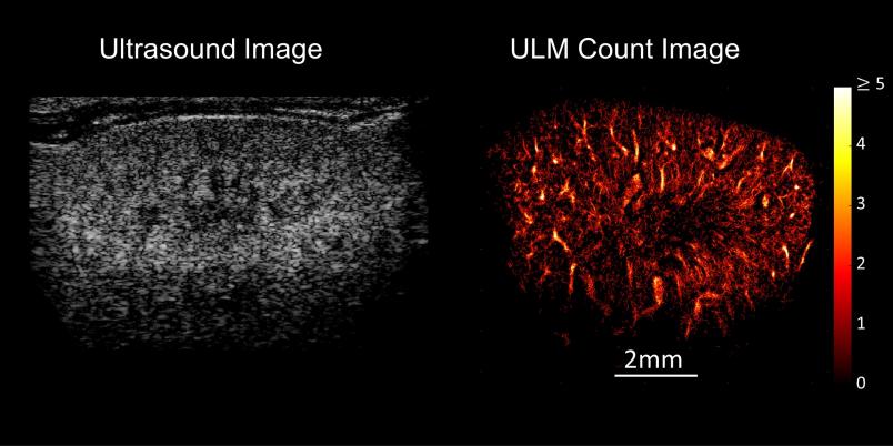 Vergleich einer herkömmlichen Ultraschallaufnahme und der Ultraschall-Lokalisations-Mikroskopie