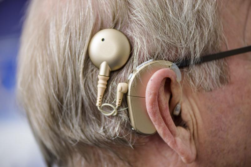 Cochlea-Implantat hinter dem Ohr eines Trägers