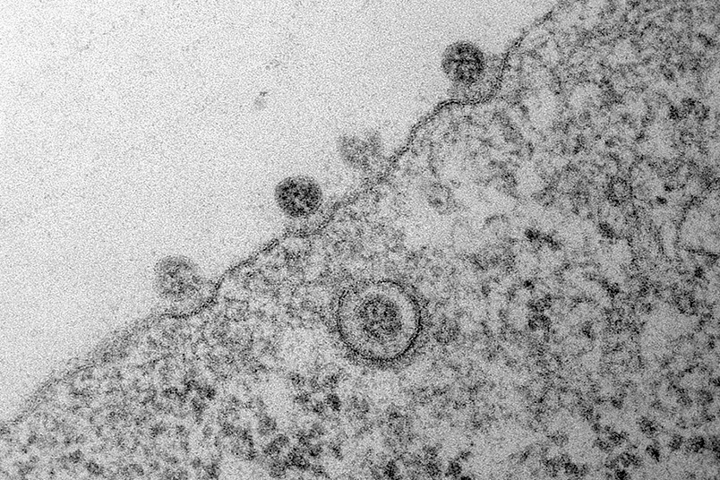Mikroskopische Aufnahme einer Infektion mit Sars-Cov-2